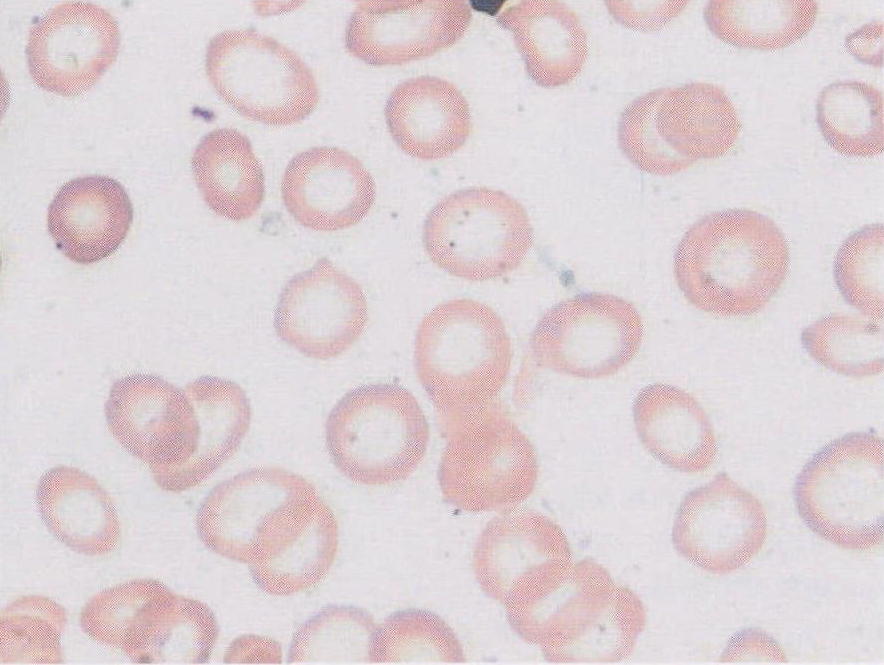 低色素性红细胞